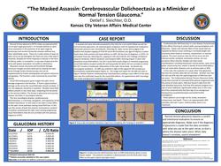 The Masked Assassin Cerebrovascular Dolichoectasia as a Mimicker of Glaucoma